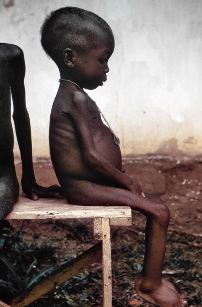 Image: A young girl suffering from kwashiorkor