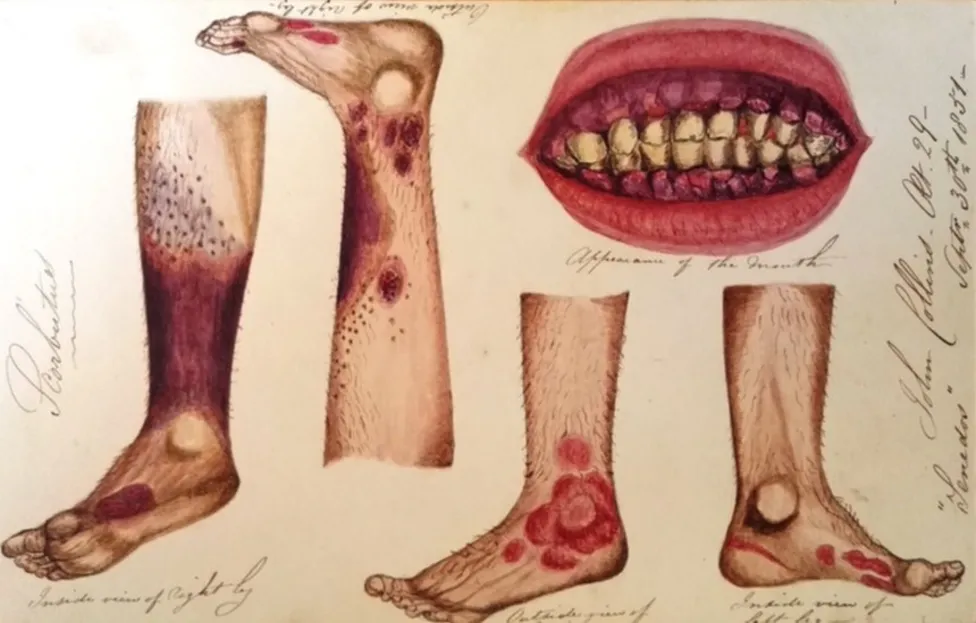  Illustrations of symptoms of Scrurvy